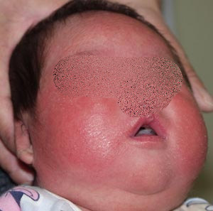 赤ちゃんの湿疹①
